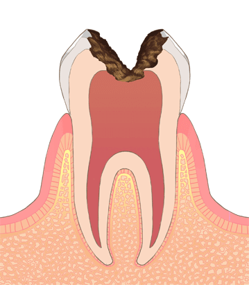 C3　神経まで進行した虫歯