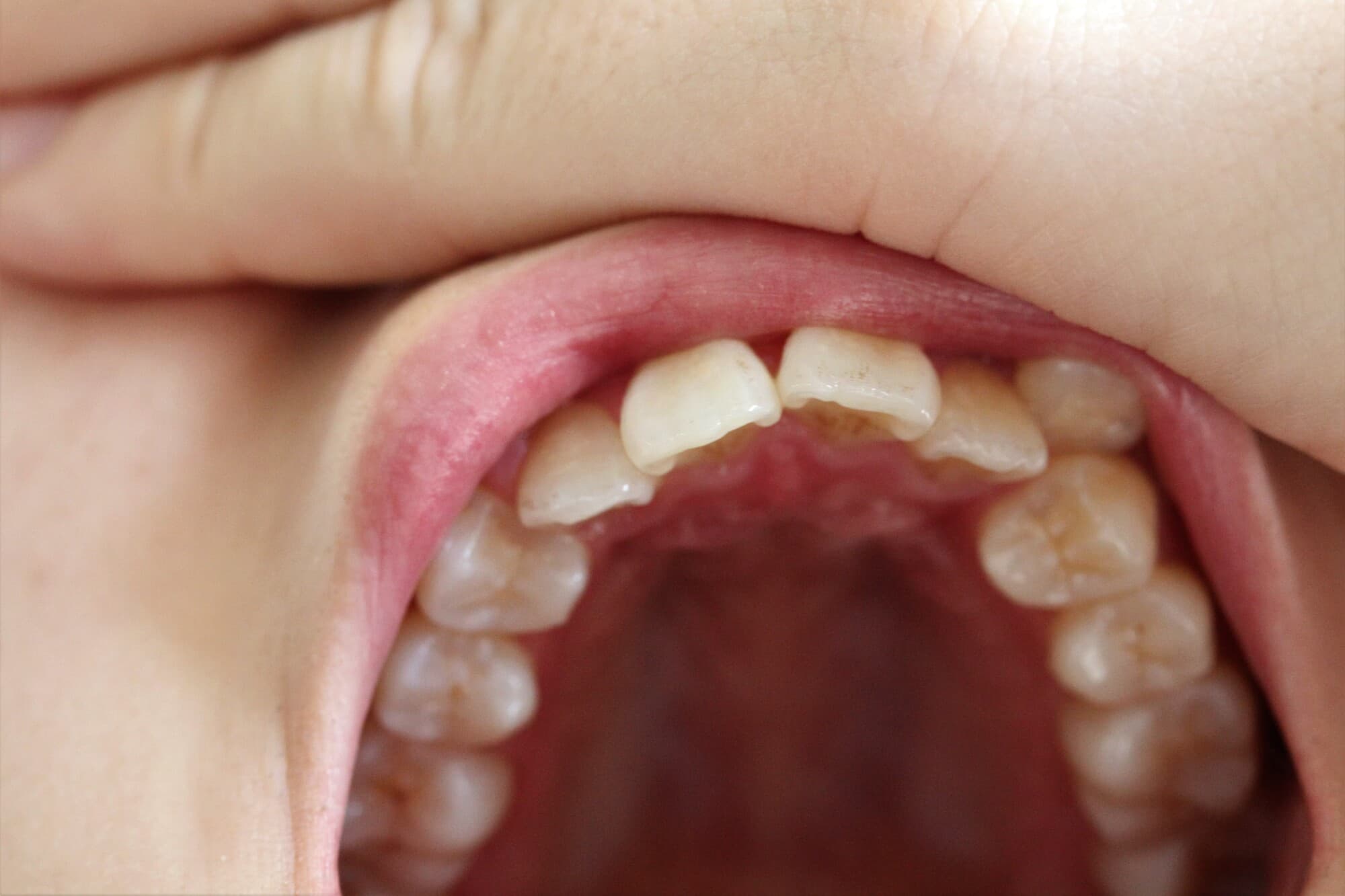 インビザラインで八重歯は治療できる？治療法や費用も解説！