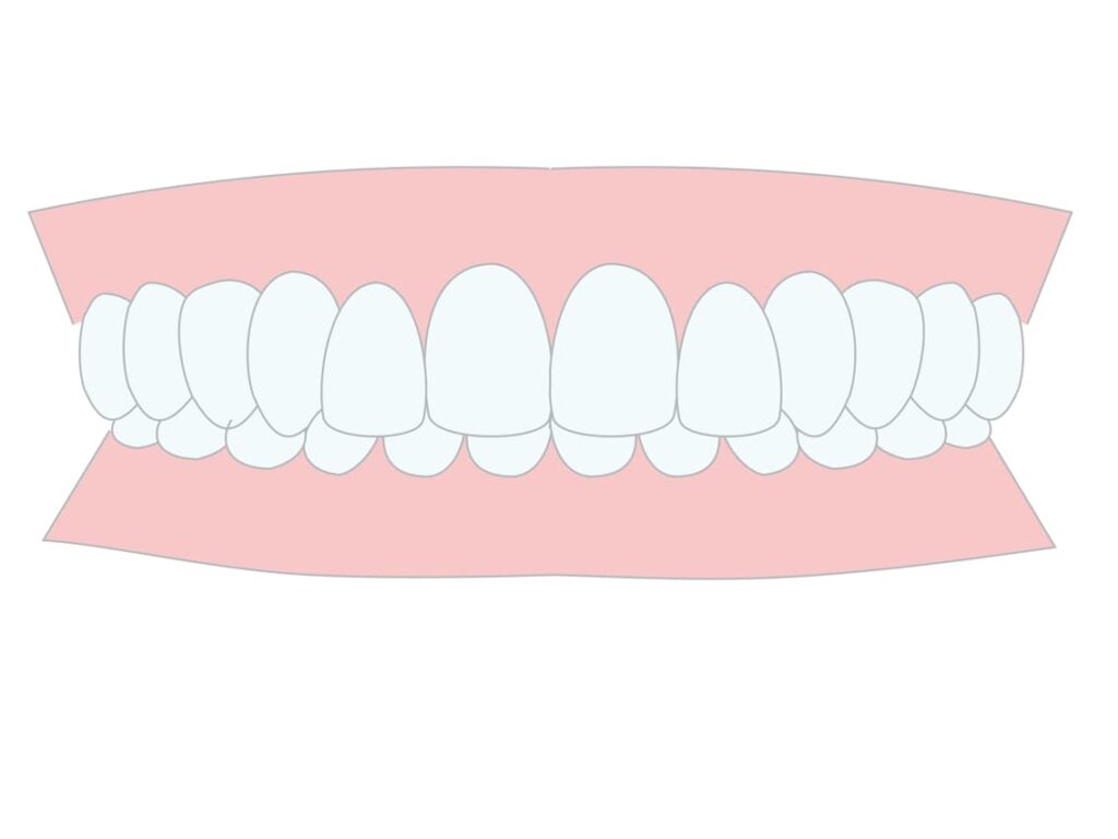 過蓋咬合のイメージ