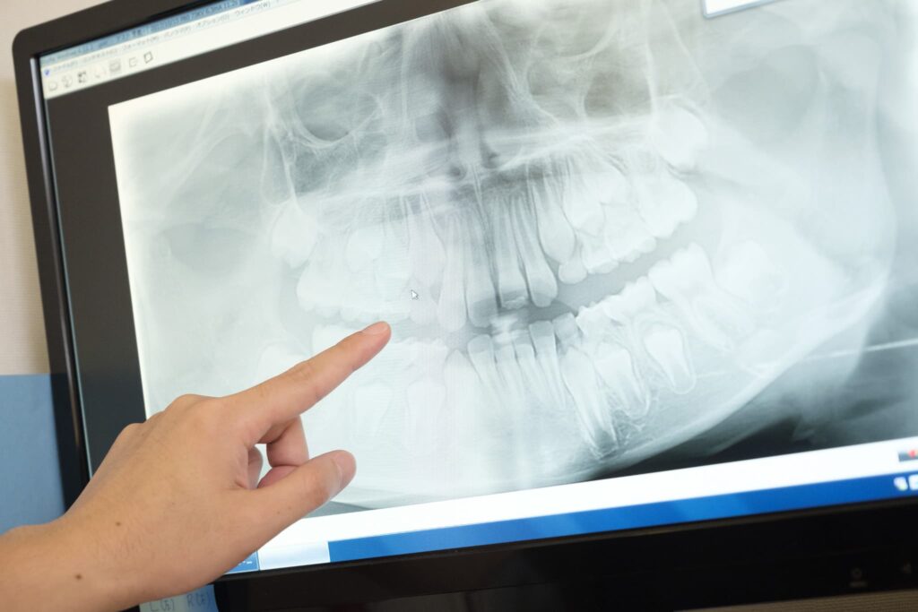 マウスピース矯正を行うためにレントゲンを確認する様子