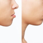 子どもの反対咬合の状態